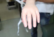 Пензячка получит индивидуальный протез за 1,5 миллиона рублей