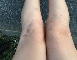 В Пензе косметолог содрал клиентке кожу и оставил гематомы на ногах
