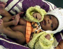 В Африке родился ребенок с четырьмя ногами