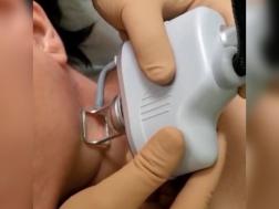 Пензенские врачи используют аппарат для омоложения кожи 